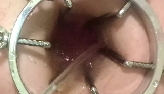 Enema, anal shower. Close-up view through anal mirror. Anal with water. Filling anal with water